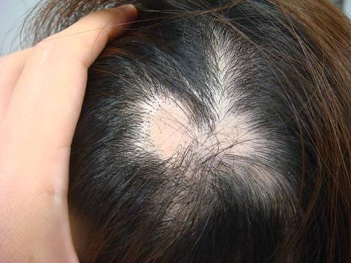 円形脱毛症は頭や眉毛などの顔面の毛が突然円形に抜けてくる病気です。